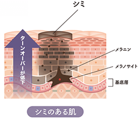 シミのしくみ